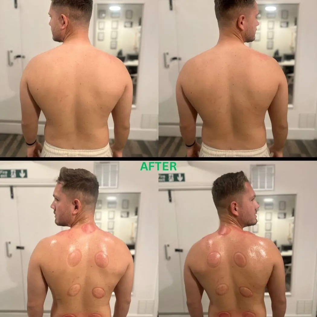 Before and after: back and shoulder cupping session at Amor Therapies