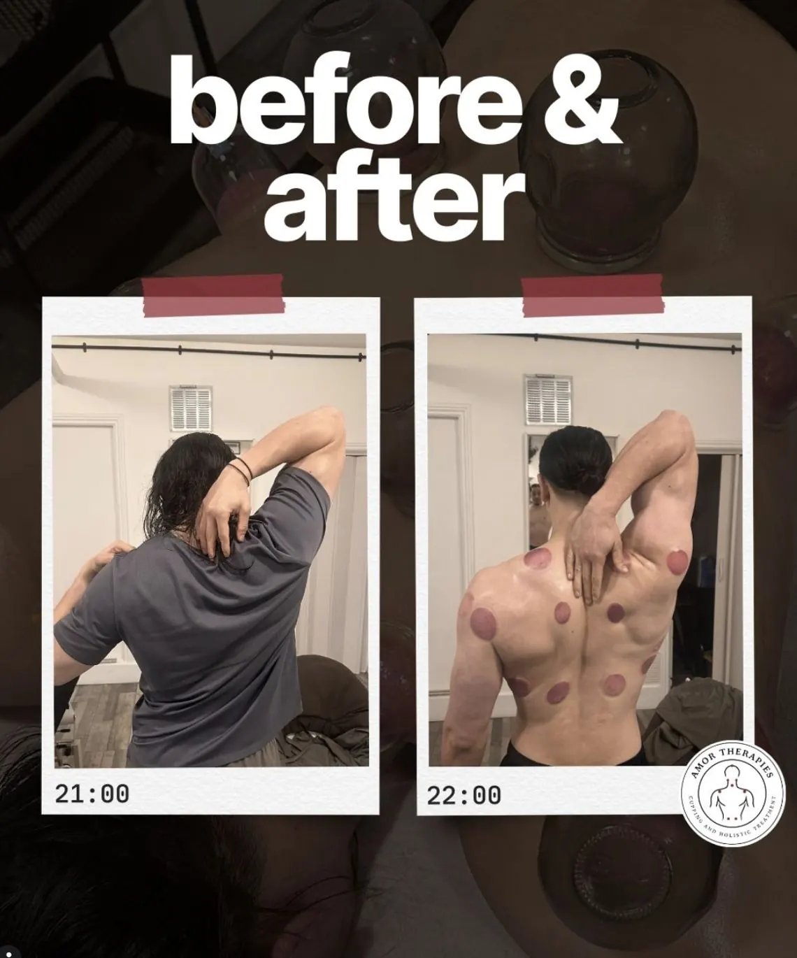 Before and after: full back hijama cupping results at Amor Therapies