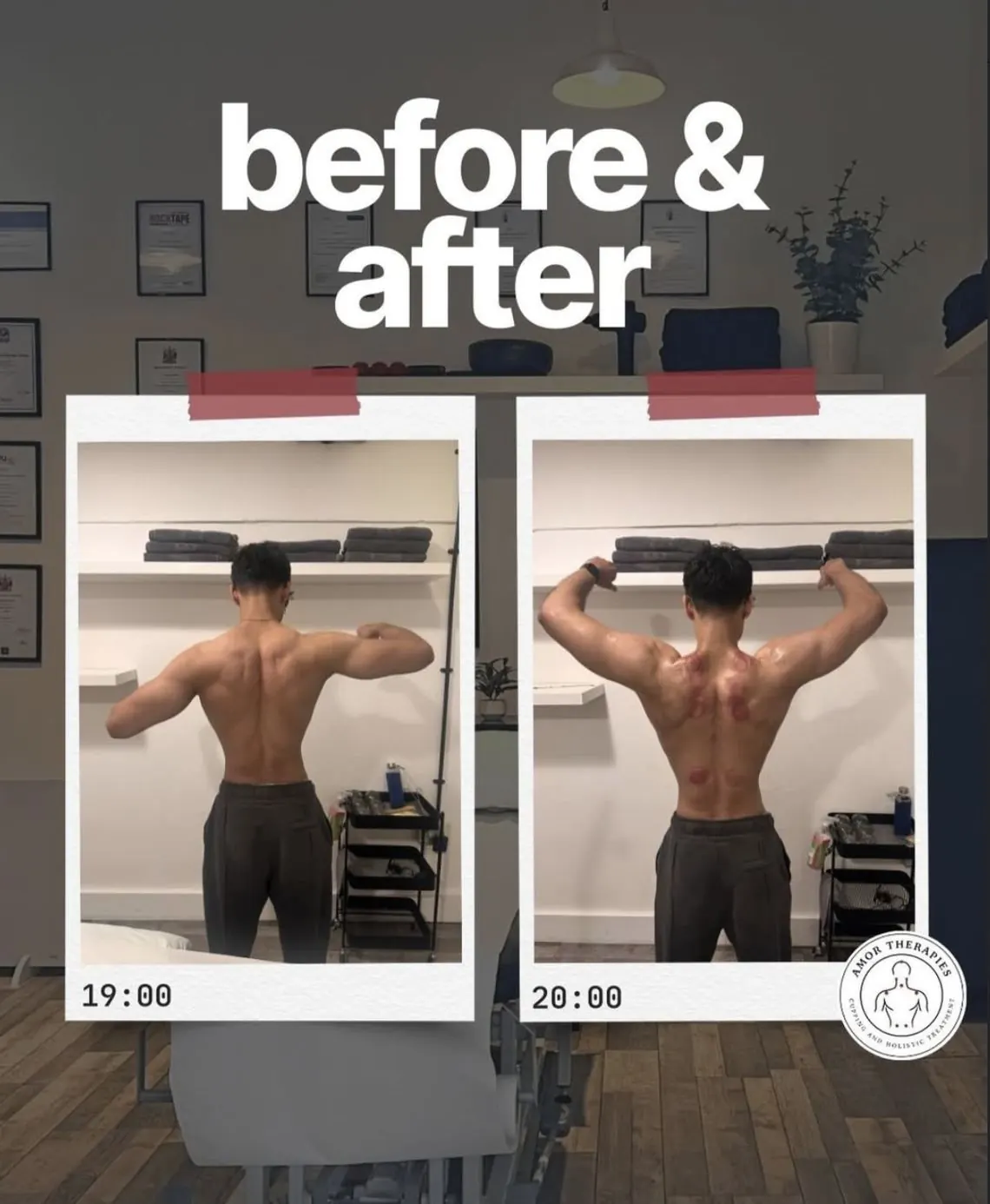 Before and after: shoulder and upper back cupping session at Amor Therapies