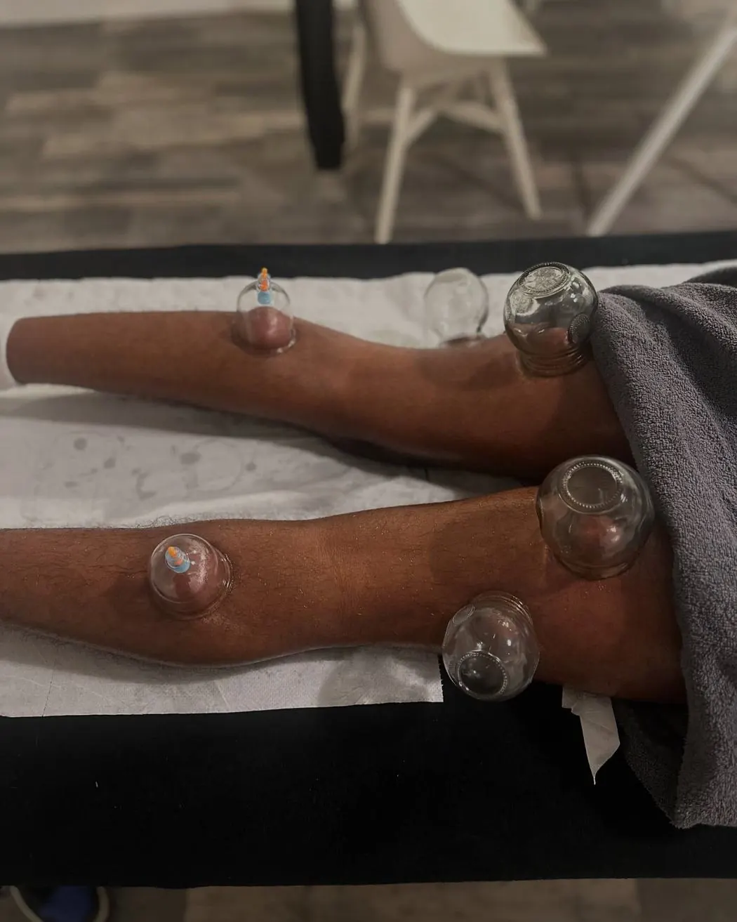Cupping therapy on arms and legs at Amor Therapies