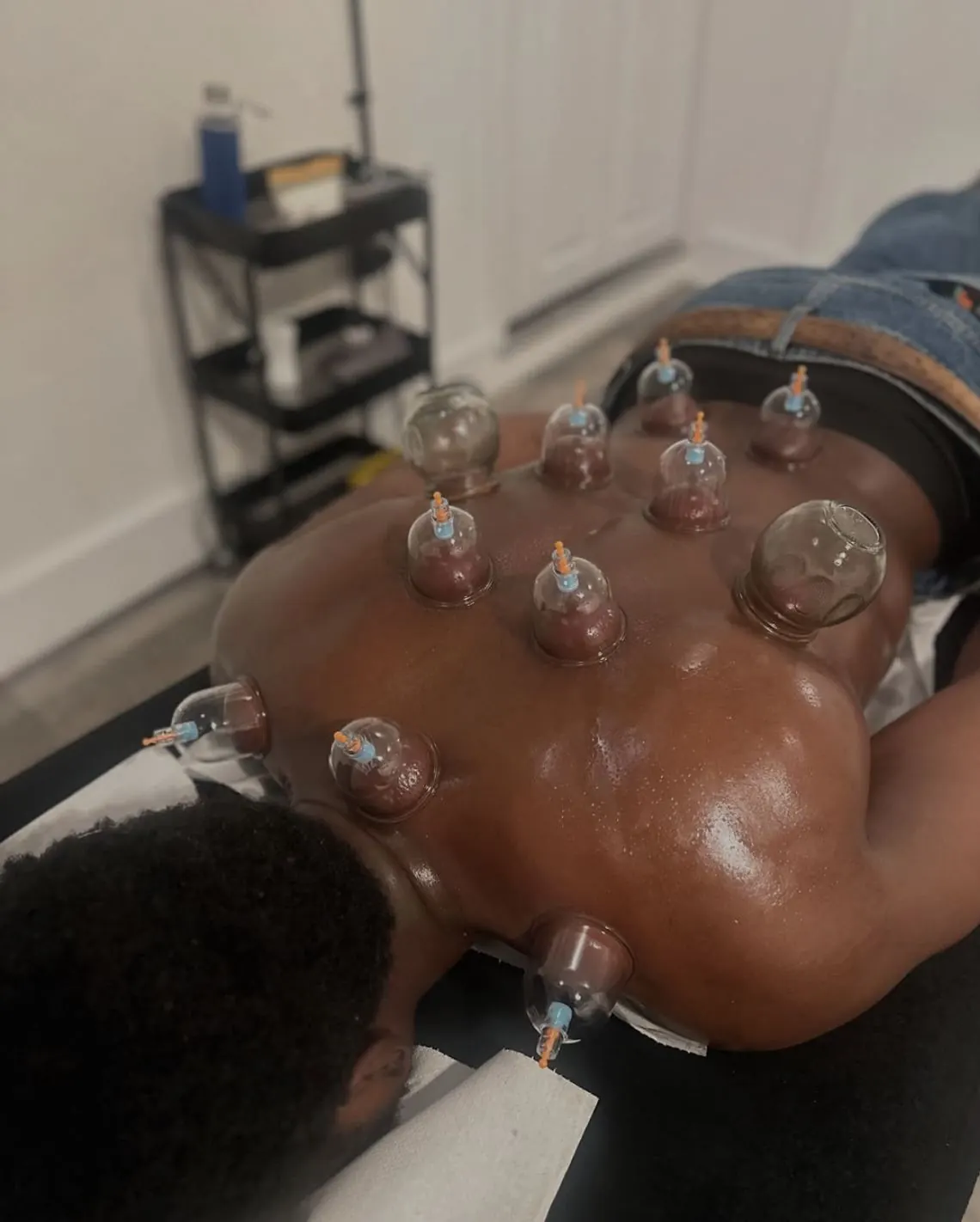 Live hijama cupping session at Amor Therapies, Bethnal Green